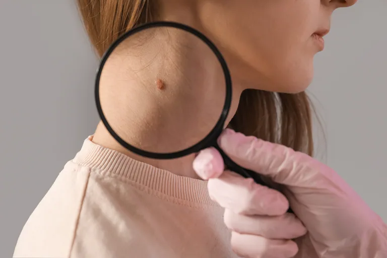 Malignant Melanoma in Bridgewater, NJ | PS Dermatology and Surgery